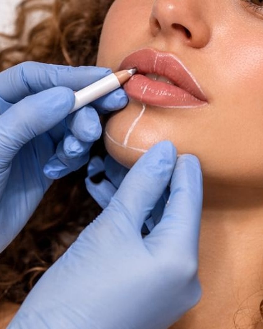 Anzeichnen der Lippenkontur vor einer Behandlung